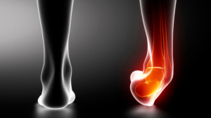 esguince de tobillo2